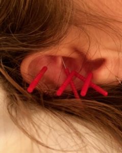 Five red handled tiny needles inserted into the ear of a person whose head rests upon a pillow