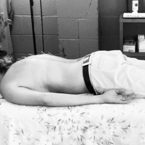 Black & white photograph of woman lying on treatment table with needles on her back